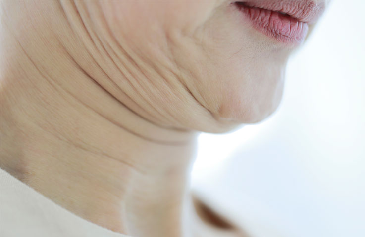 늘어짐형 목주름